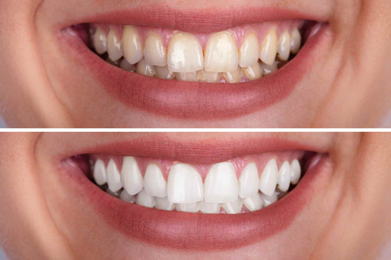 Bleaching vorher und nachher – professionelle Zahnaufhellung