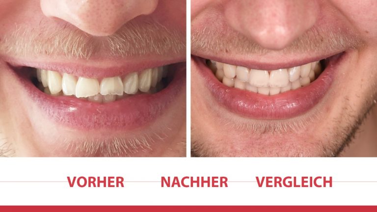 Veneers-Vorher-Nacher-Vergleich-768x432