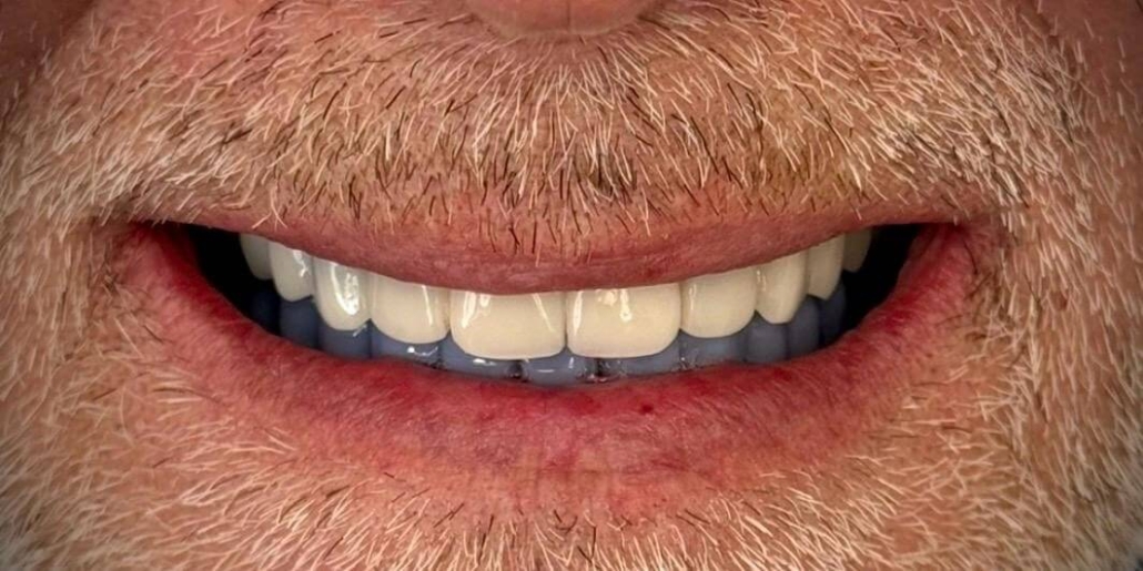 Vollständige Zahnreihe nach der Versorgung mit 16 Implantaten